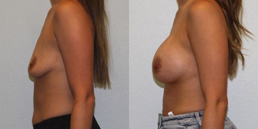 Breast Augmentation - Thumbnail 3