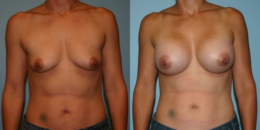 Breast Augmentation - Case 19297