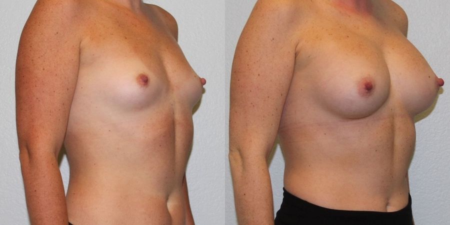 Breast Augmentation - Thumbnail 2