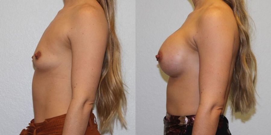 Breast Augmentation - Thumbnail 3
