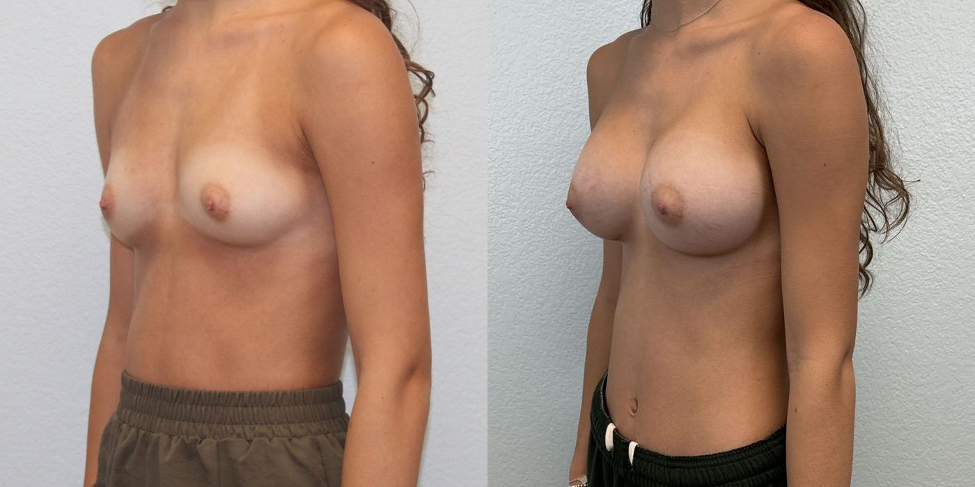 Breast Augmentation - Thumbnail 2