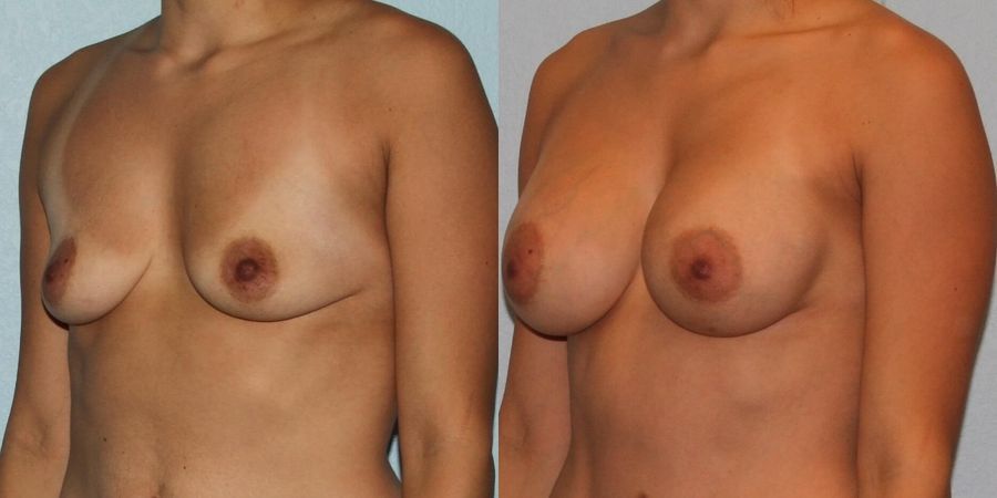 Breast Augmentation - Thumbnail 2