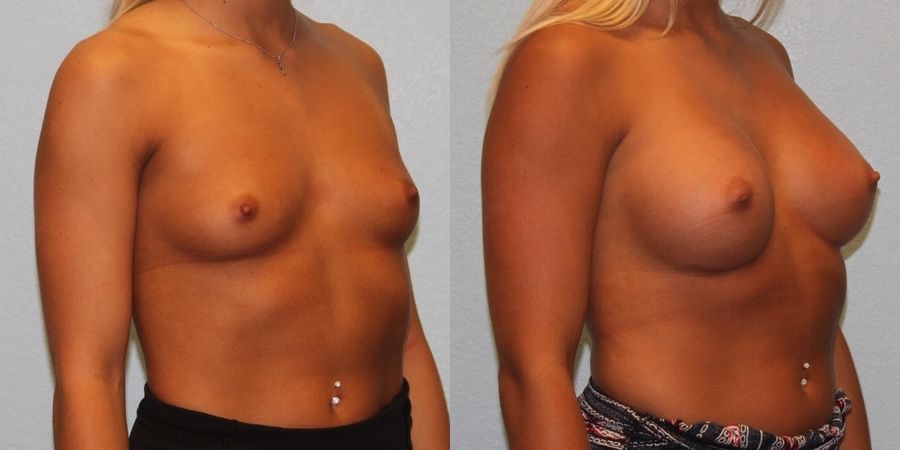 Breast Augmentation - Thumbnail 2