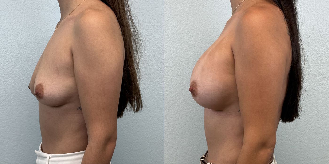 Breast Augmentation - Thumbnail 3