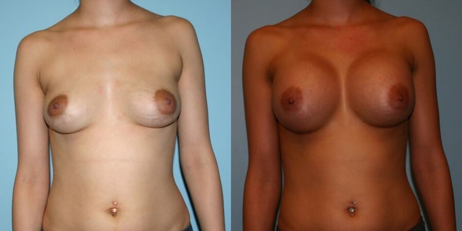 Breast Augmentation - Case 19298