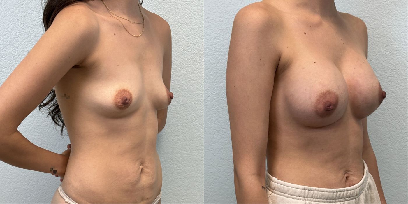 Breast Augmentation - Thumbnail 2