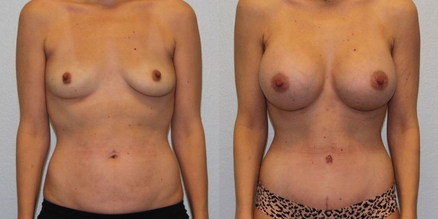 Breast Augmentation - Case 19267