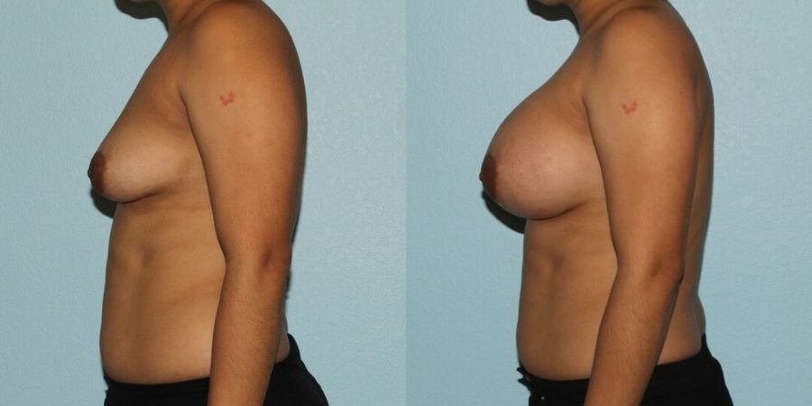 Breast Augmentation - Thumbnail 3