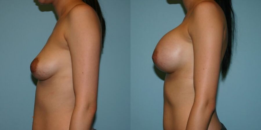 Breast Augmentation - Thumbnail 3