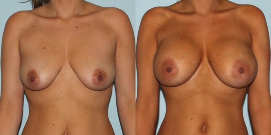Breast Augmentation - Case 19293