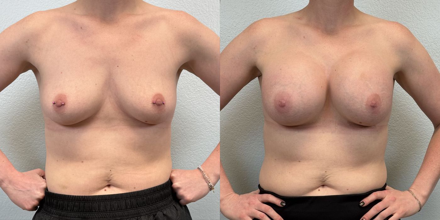 Breast Augmentation - Case 19251