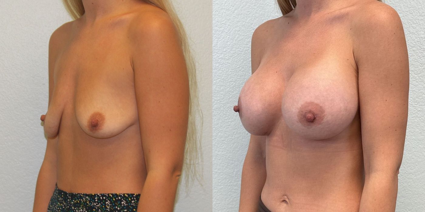 Breast Augmentation - Thumbnail 2