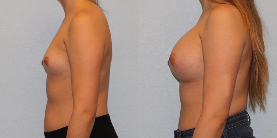 Breast Augmentation - Thumbnail 3