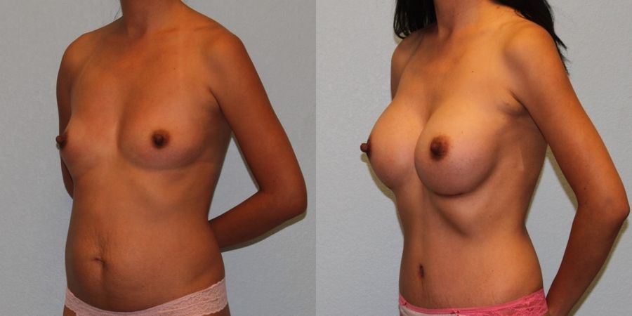 Breast Augmentation - Thumbnail 2
