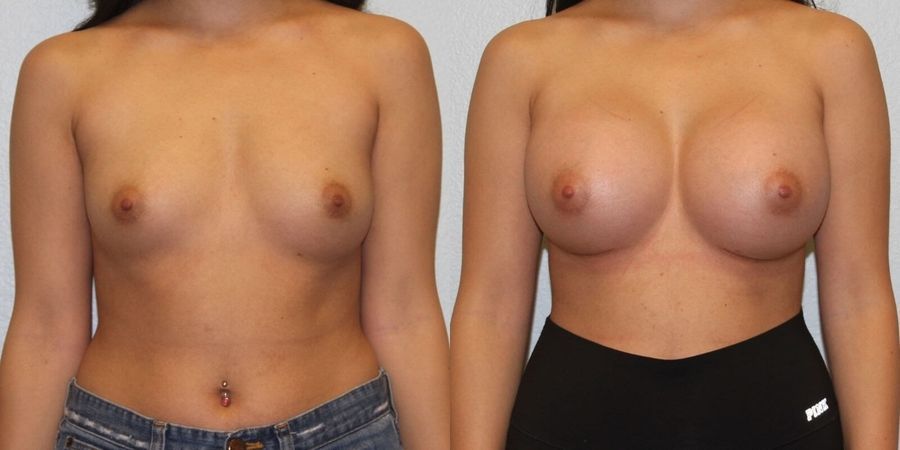 Breast Augmentation - Case 19316