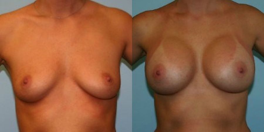 Breast Augmentation - Case 19287