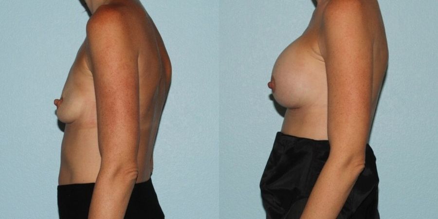 Breast Augmentation - Thumbnail 3