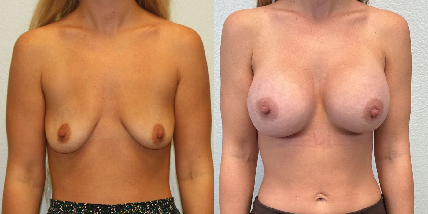 Breast Augmentation - Case 19259