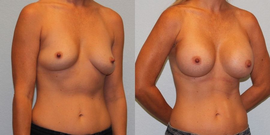 Breast Augmentation - Thumbnail 2