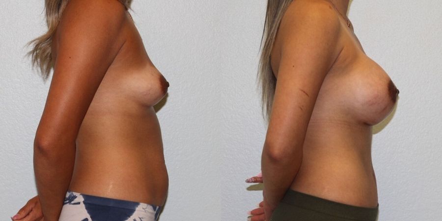 Breast Augmentation - Thumbnail 3