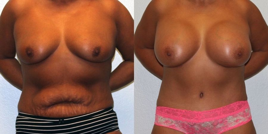 Breast Augmentation - Case 19271