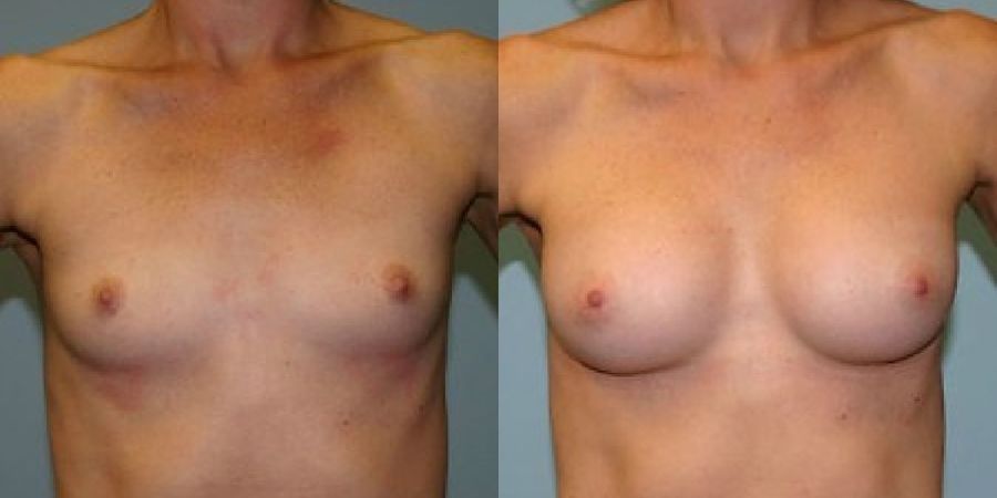 Breast Augmentation - Case 19291