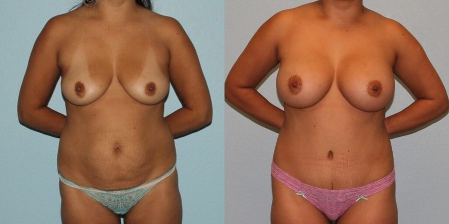 Breast Augmentation - Case 19275