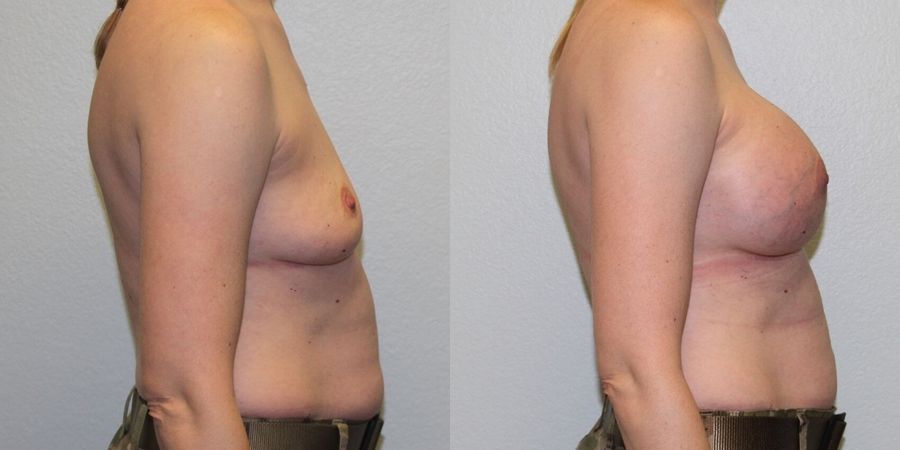 Breast Augmentation - Thumbnail 3