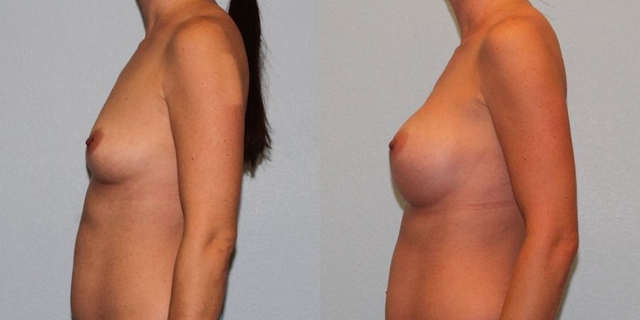 Breast Augmentation - Thumbnail 3