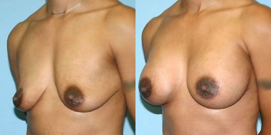 Breast Augmentation - Thumbnail 2