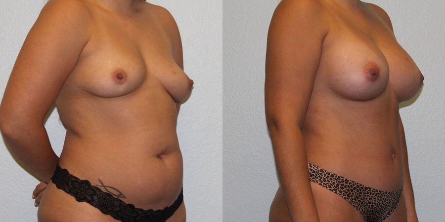 Breast Augmentation - Thumbnail 2