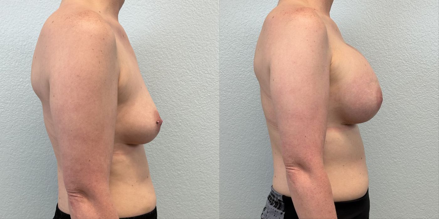 Breast Augmentation - Thumbnail 3