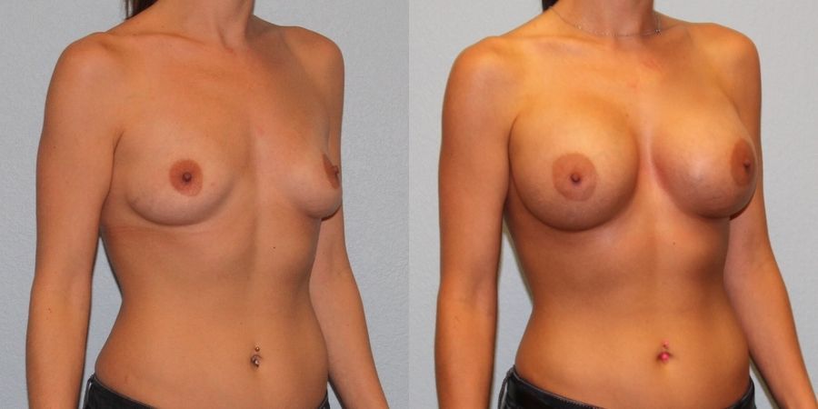 Breast Augmentation - Thumbnail 2