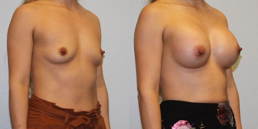 Breast Augmentation - Thumbnail 2