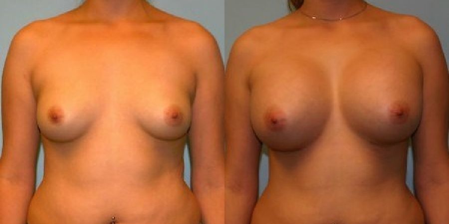 Breast Augmentation - Case 19288
