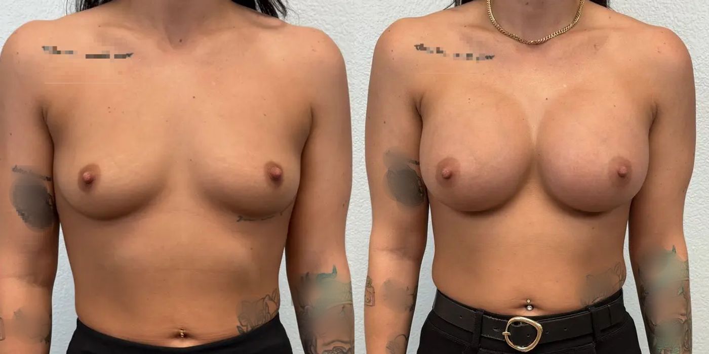 Breast Augmentation - Case 19253
