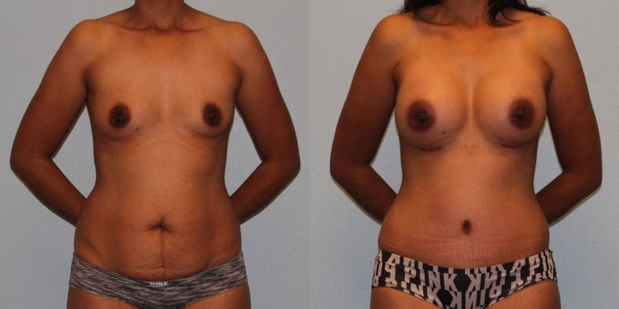 Breast Augmentation - Case 19273