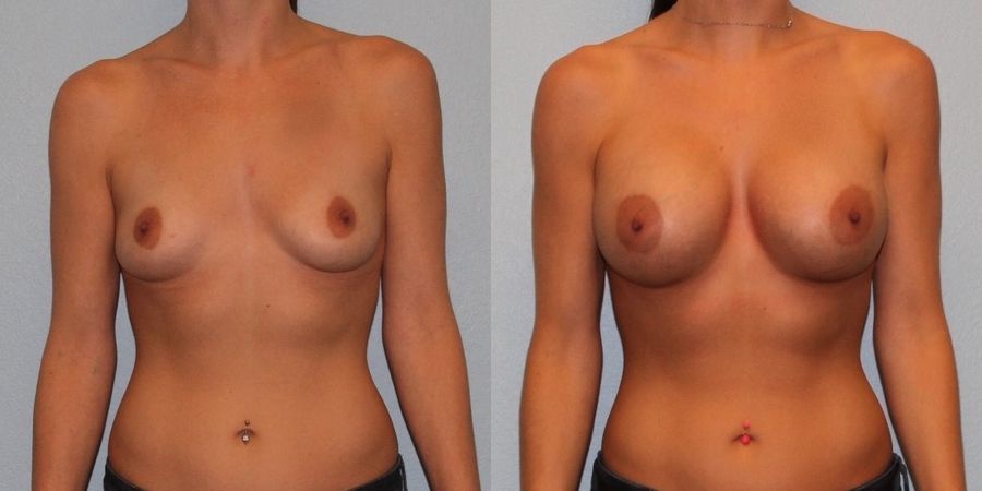Breast Augmentation - Case 19306