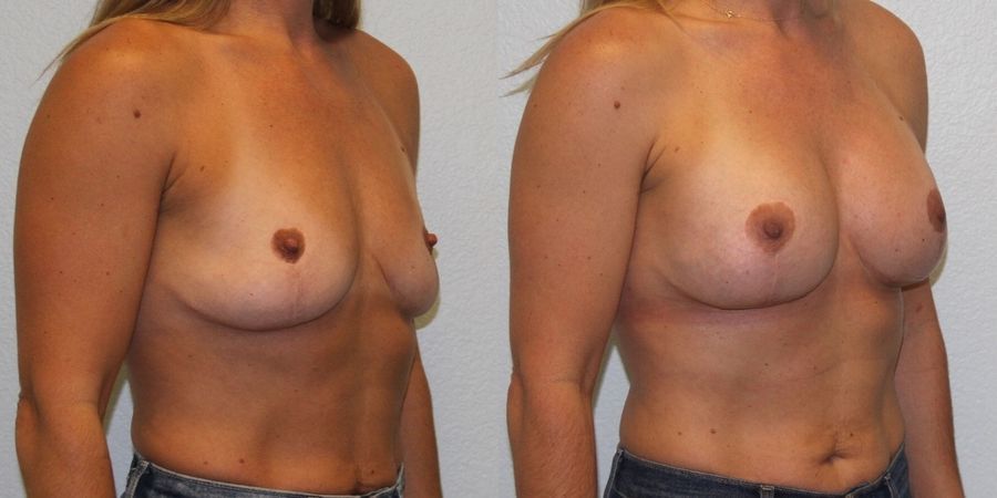 Breast Augmentation - Thumbnail 2
