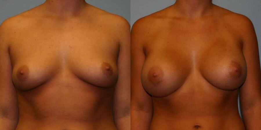 Breast Augmentation - Case 19295
