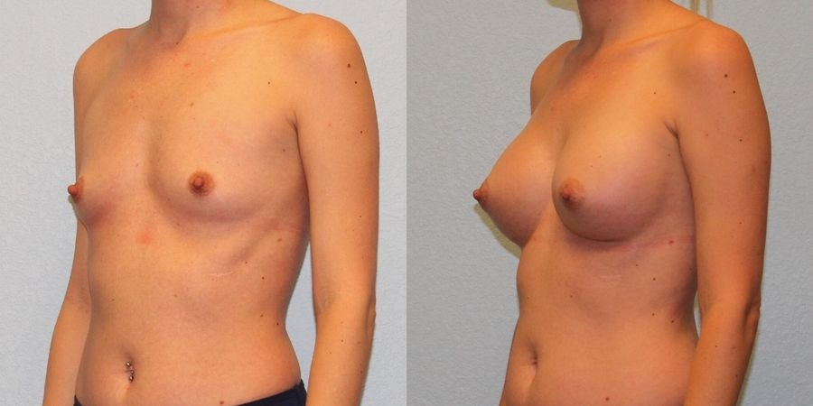 Breast Augmentation - Thumbnail 2
