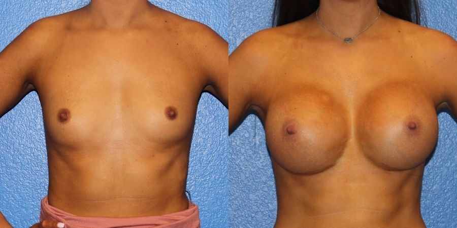 Breast Augmentation - Case 19330