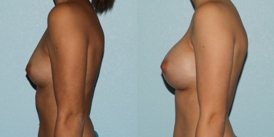 Breast Augmentation - Thumbnail 3