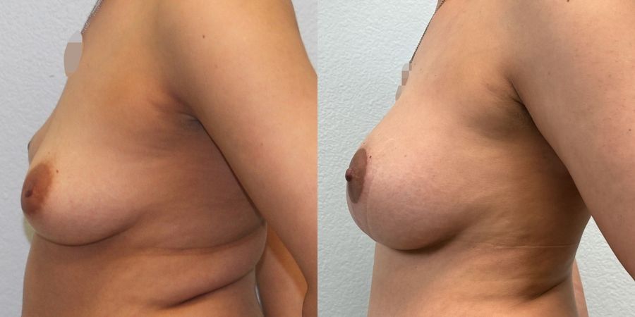 Breast Augmentation - Thumbnail 3