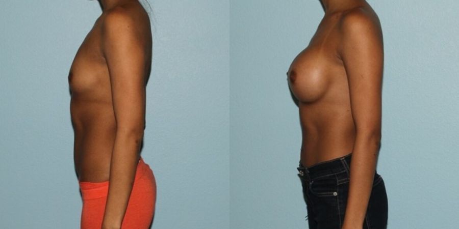 Breast Augmentation - Thumbnail 3