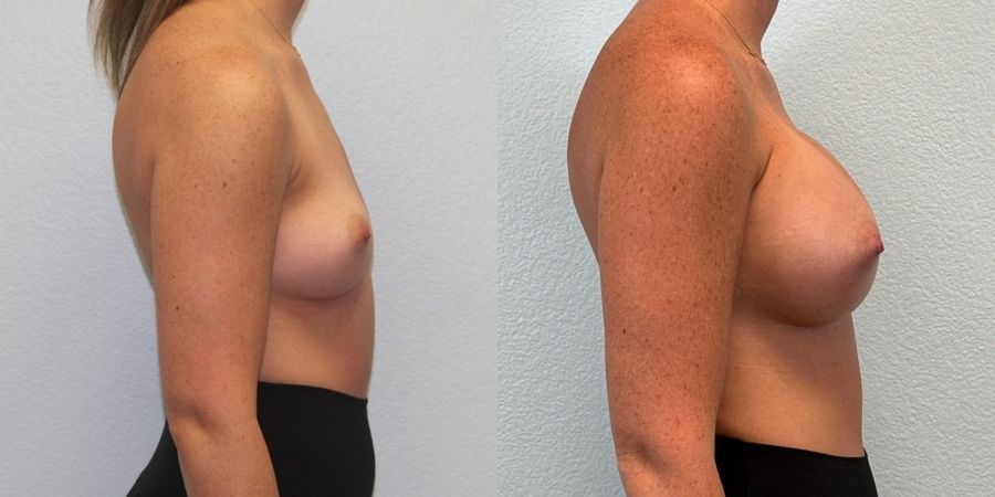 Breast Augmentation - Thumbnail 3