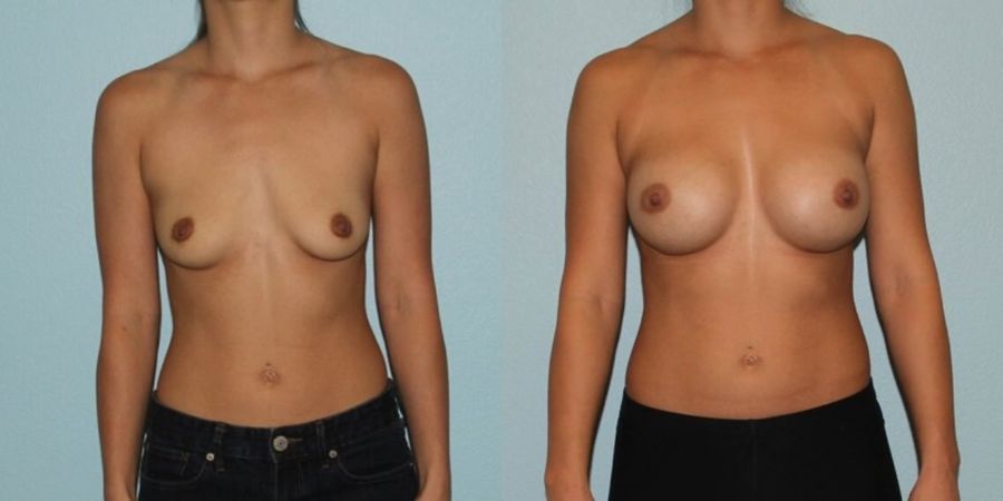 Breast Augmentation - Case 19336