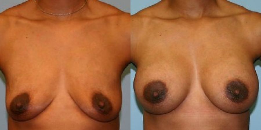 Breast Augmentation - Case 19292