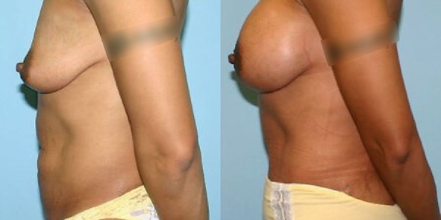 Breast Augmentation - Thumbnail 4