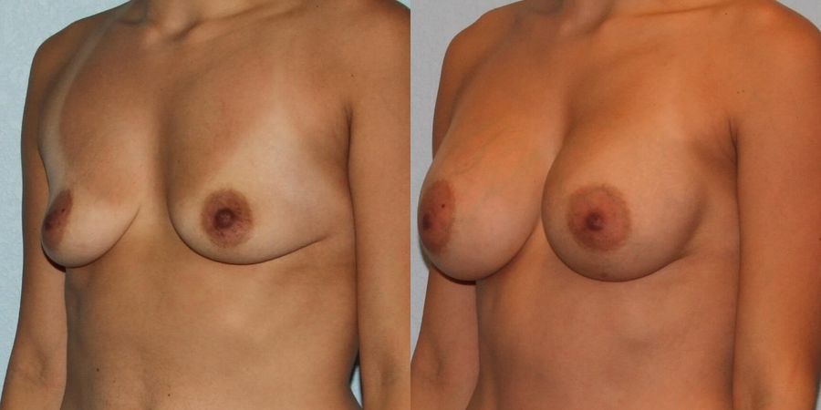 Breast Augmentation - Thumbnail 2